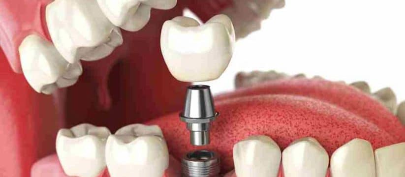 implantes dentales valencia